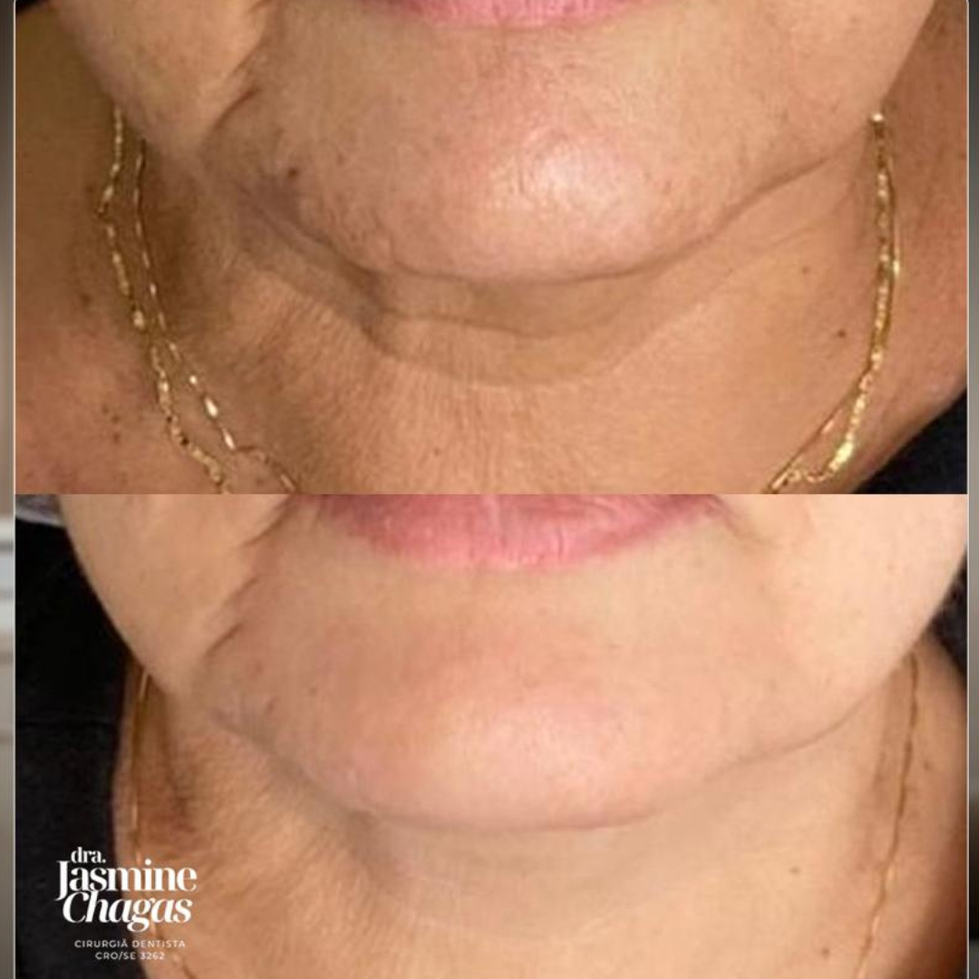 Antes e depois - tratamento de bigode chinês